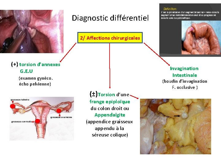 V. Diagnostic différentiel 2/ Affections chirurgicales (+) torsion d’annexes Invagination Intestinale G. E. U