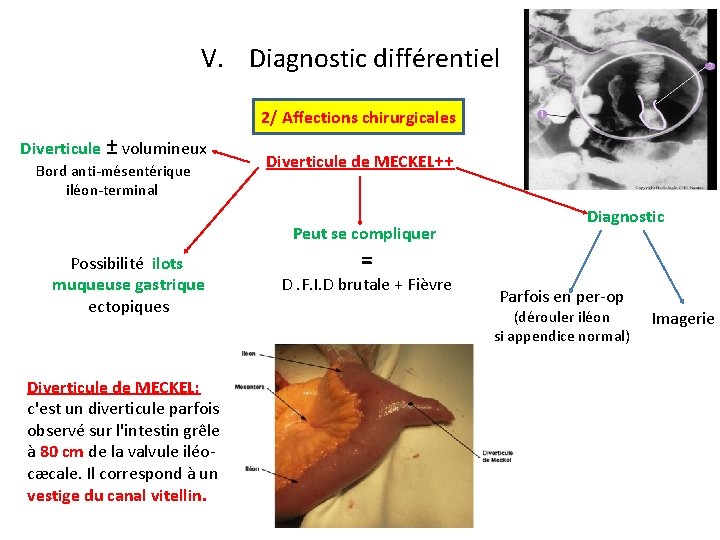 V. Diagnostic différentiel 2/ Affections chirurgicales Diverticule ± volumineux Bord anti-mésentérique iléon-terminal Diverticule de