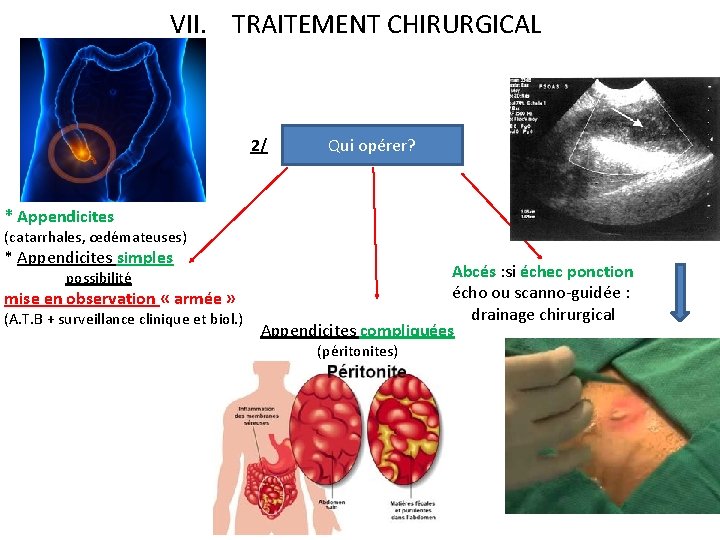 VII. TRAITEMENT CHIRURGICAL 2/ Qui opérer? * Appendicites (catarrhales, œdémateuses) * Appendicites simples Abcés