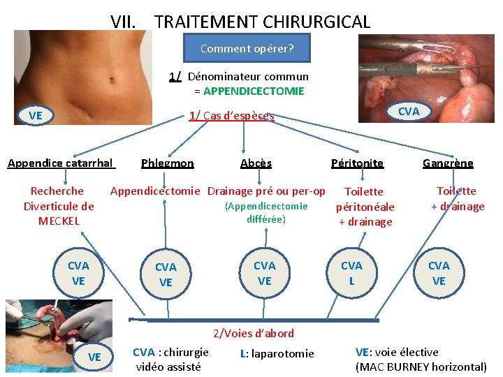 VII. TRAITEMENT CHIRURGICAL Comment opérer? 1/ Dénominateur commun = APPENDICECTOMIE VE CVA 1/ Cas