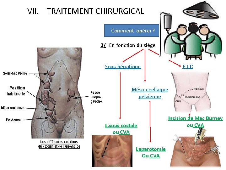 VII. TRAITEMENT CHIRURGICAL Comment opérer? 2/ En fonction du siège Sous-hépatique F. I. D