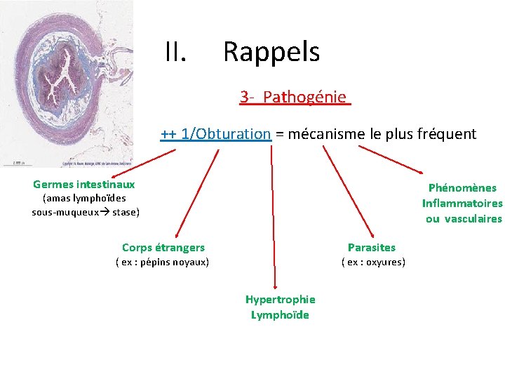 II. Rappels 3 - Pathogénie ++ 1/Obturation = mécanisme le plus fréquent Germes intestinaux