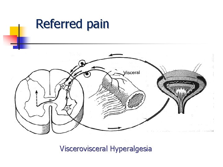Referred pain Viscerovisceral Hyperalgesia Referred pain Viscerovisceral Hyperalgesia