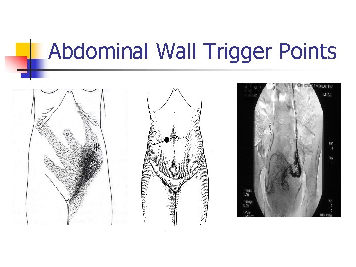 Abdominal Wall Trigger Points Abdominal Wall Trigger Points
