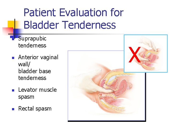 Patient Evaluation for Bladder Tenderness n n Suprapubic tenderness Anterior vaginal wall/ bladder base Patient Evaluation for Bladder Tenderness n n Suprapubic tenderness Anterior vaginal wall/ bladder base