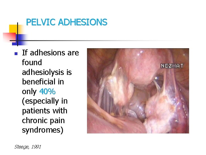 PELVIC ADHESIONS n If adhesions are found adhesiolysis is beneficial in only 40% (especially PELVIC ADHESIONS n If adhesions are found adhesiolysis is beneficial in only 40% (especially