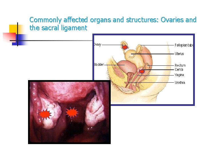 Commonly affected organs and structures: Ovaries and the sacral ligament Commonly affected organs and structures: Ovaries and the sacral ligament