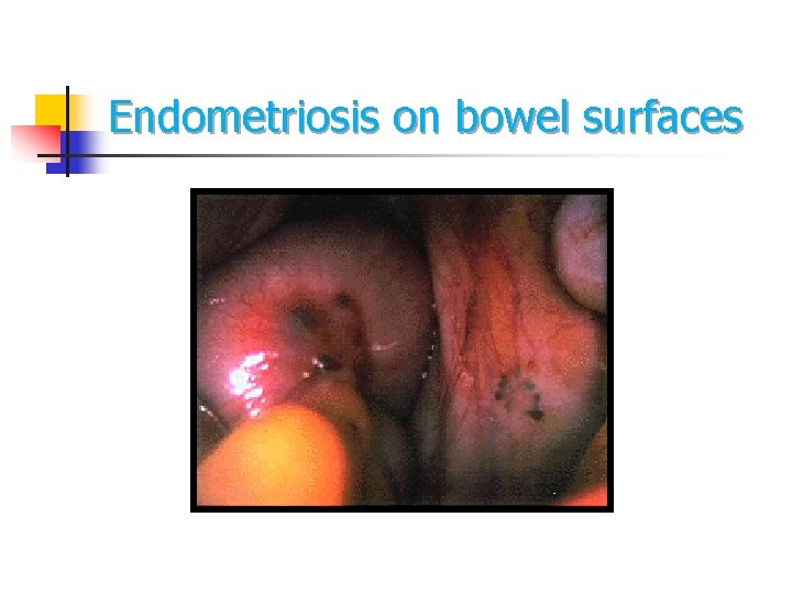 Endometriosis on bowel surfaces Endometriosis on bowel surfaces