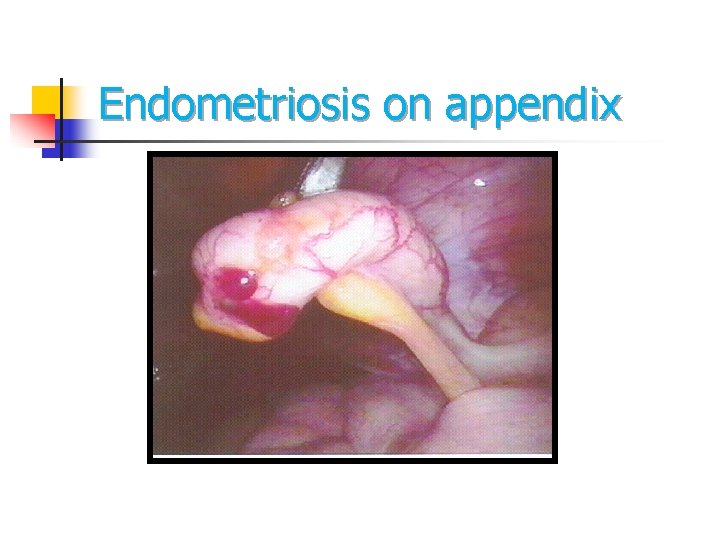 Endometriosis on appendix Endometriosis on appendix