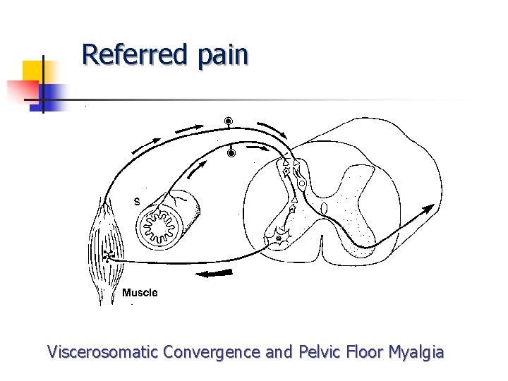 Referred pain Viscerosomatic Convergence and Pelvic Floor Myalgia Referred pain Viscerosomatic Convergence and Pelvic Floor Myalgia