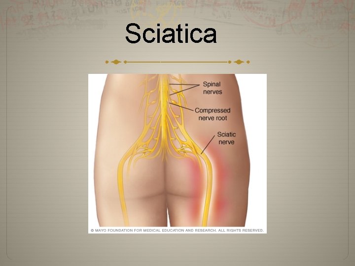 Sciatica 