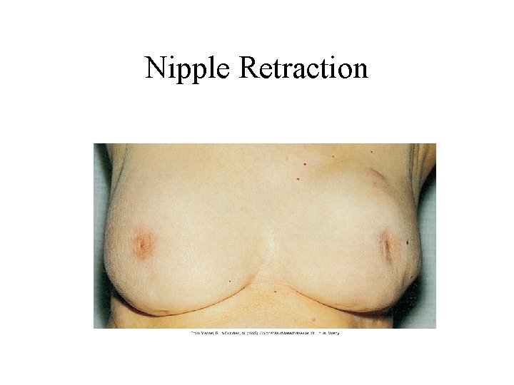 Nipple Retraction Nipple Retraction
