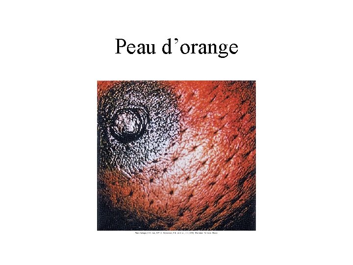 Peau d’orange Peau d’orange