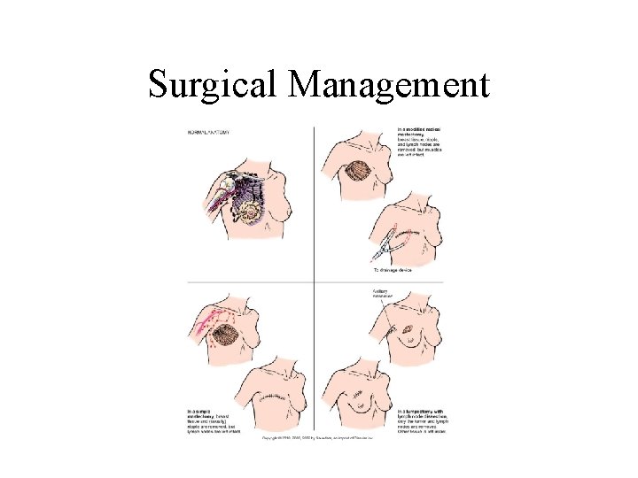 Surgical Management Surgical Management