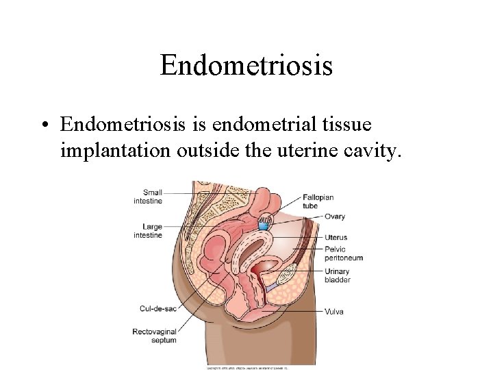 Endometriosis • Endometriosis is endometrial tissue implantation outside the uterine cavity. Endometriosis • Endometriosis is endometrial tissue implantation outside the uterine cavity.