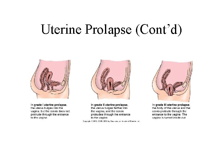 Uterine Prolapse (Cont’d) Uterine Prolapse (Cont’d)