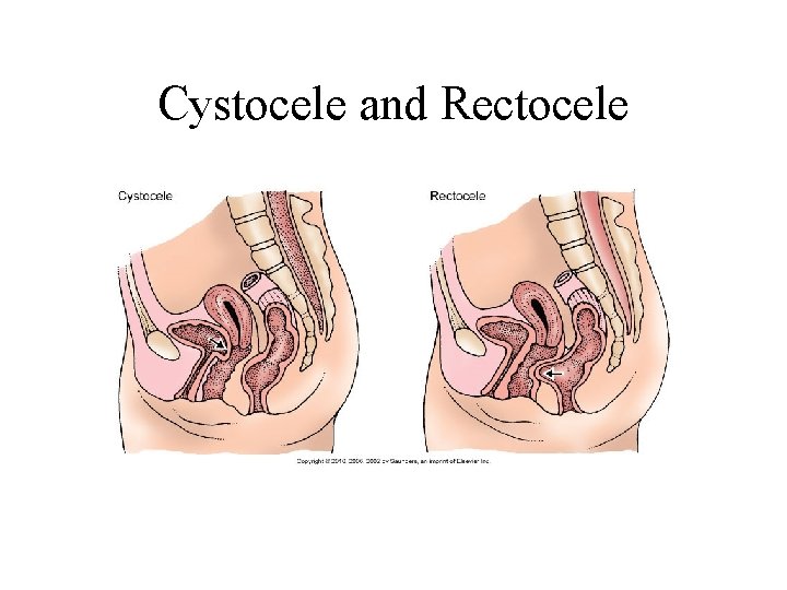 Cystocele and Rectocele Cystocele and Rectocele