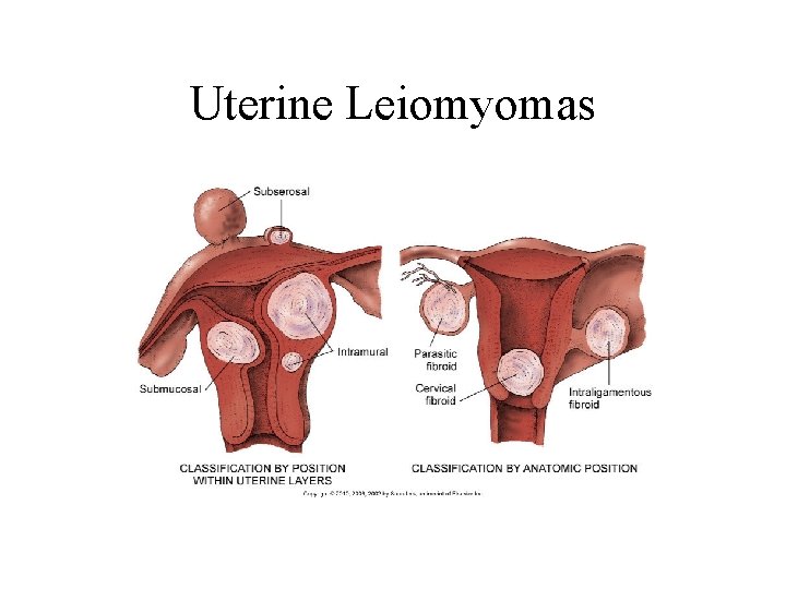 Uterine Leiomyomas Uterine Leiomyomas