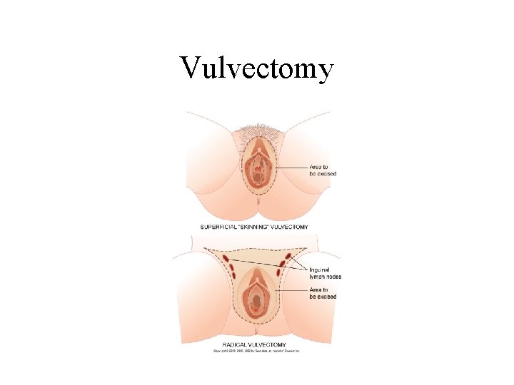 Vulvectomy Vulvectomy