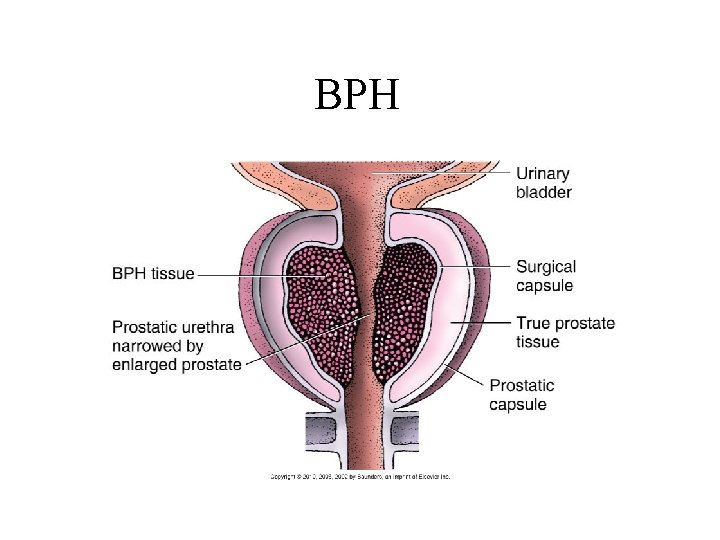 BPH BPH