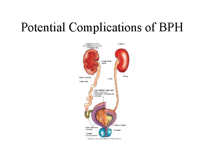 Potential Complications of BPH Potential Complications of BPH