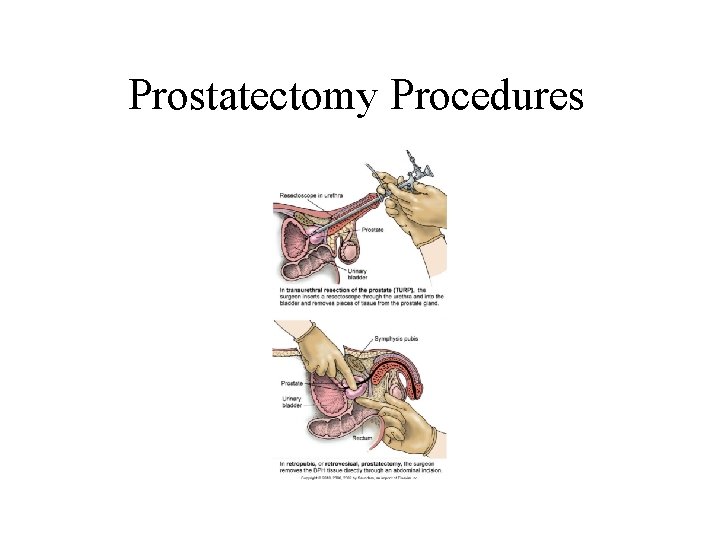 Prostatectomy Procedures Prostatectomy Procedures