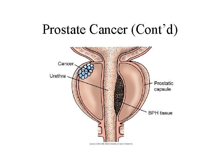 Prostate Cancer (Cont’d) Prostate Cancer (Cont’d)