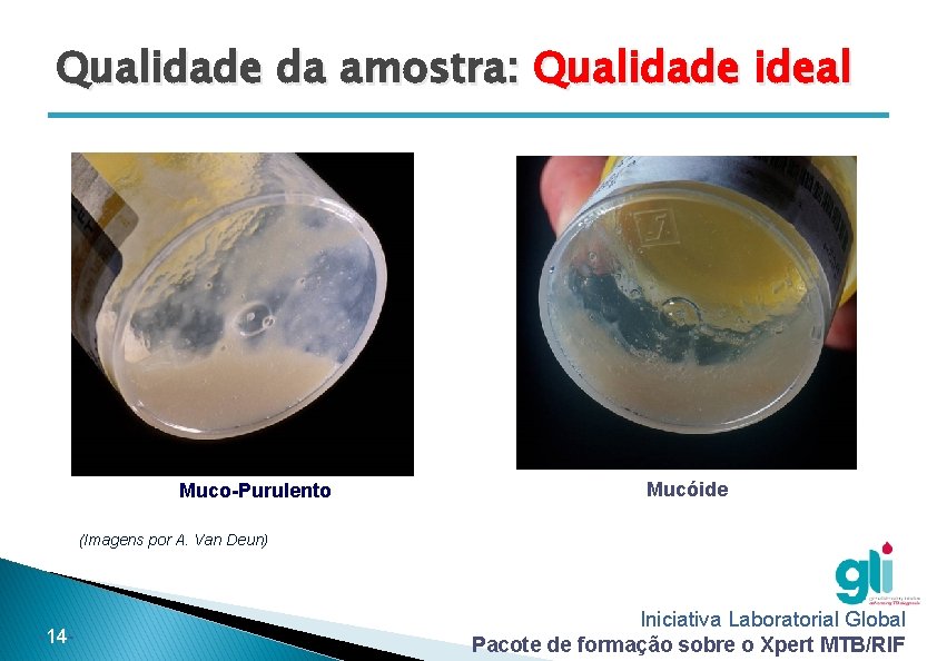 Qualidade da amostra: Qualidade ideal Muco-Purulento Mucóide (Imagens por A. Van Deun) -14 - Qualidade da amostra: Qualidade ideal Muco-Purulento Mucóide (Imagens por A. Van Deun) -14 -