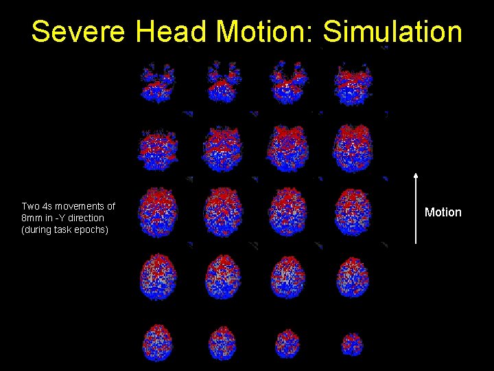 Severe Head Motion: Simulation Two 4 s movements of 8 mm in -Y direction