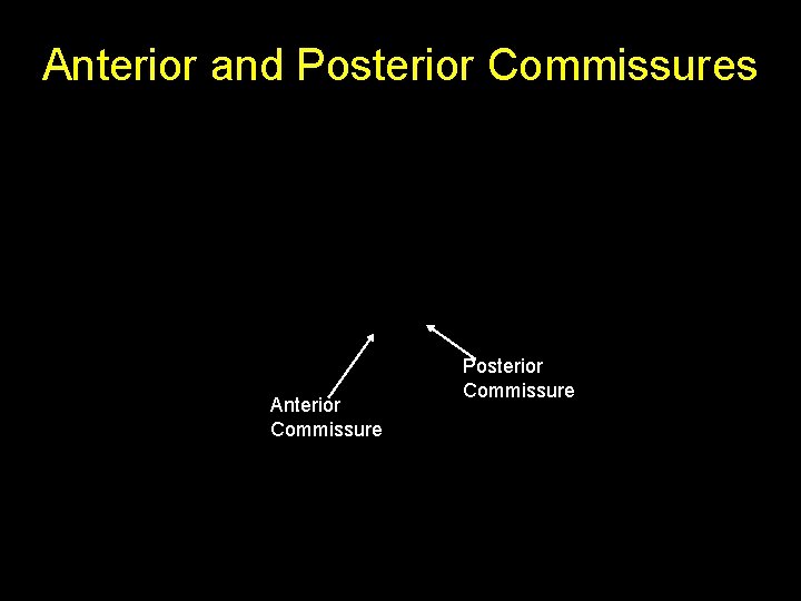 Anterior and Posterior Commissures Anterior Commissure Posterior Commissure 