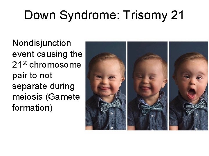 Down Syndrome: Trisomy 21 Nondisjunction event causing the 21 st chromosome pair to not