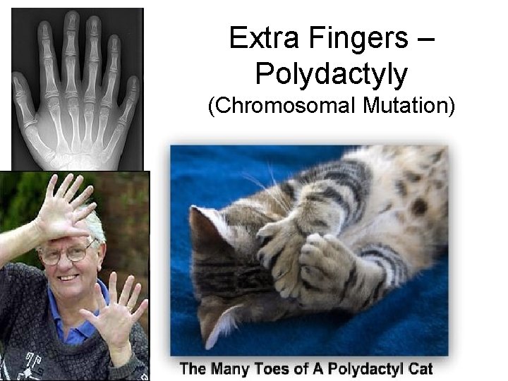 Extra Fingers – Polydactyly (Chromosomal Mutation) 