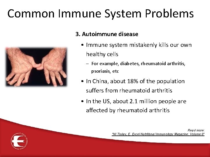 Common Immune System Problems 3. Autoimmune disease • Immune system mistakenly kills our own