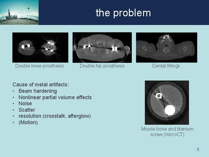 the problem Double knee prosthesis Double hip prosthesis Dental fillings Cause of metal artifacts: