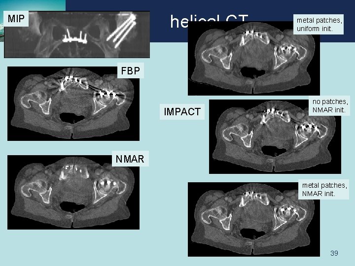 helical CT MIP metal patches, uniform init. FBP IMPACT no patches, NMAR init. NMAR