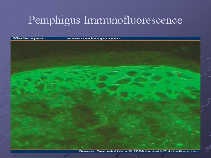 Pemphigus Immunofluorescence 