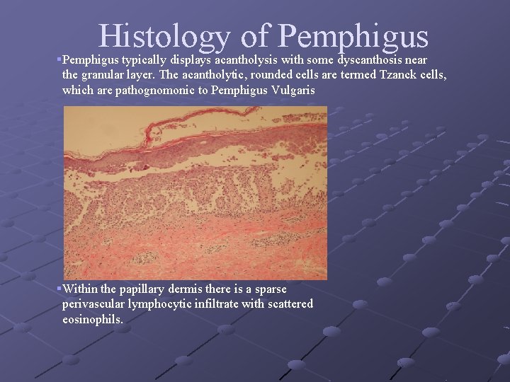 Histology of Pemphigus §Pemphigus typically displays acantholysis with some dyscanthosis near the granular layer.