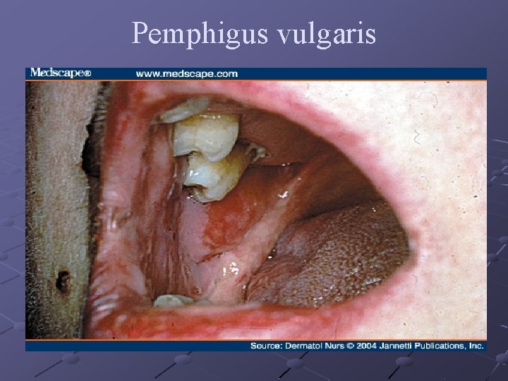 Pemphigus vulgaris 