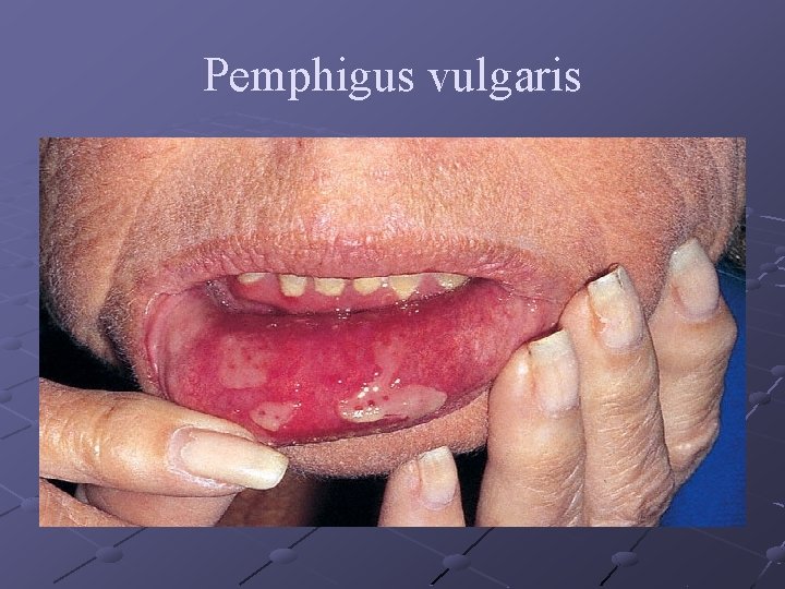 Pemphigus vulgaris 