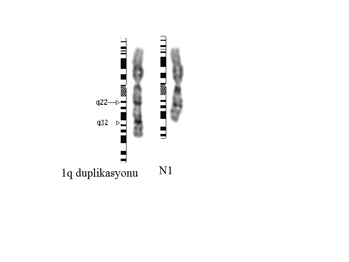 1 q duplikasyonu N 1 