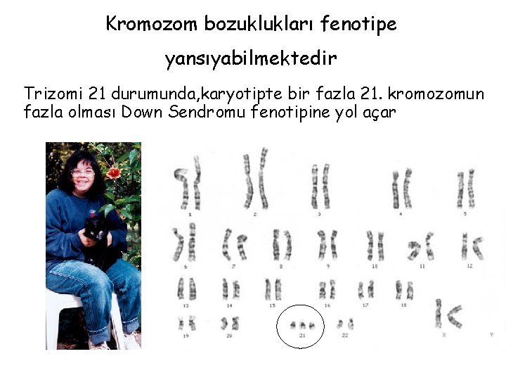 Kromozom bozuklukları fenotipe yansıyabilmektedir Trizomi 21 durumunda, karyotipte bir fazla 21. kromozomun fazla olması