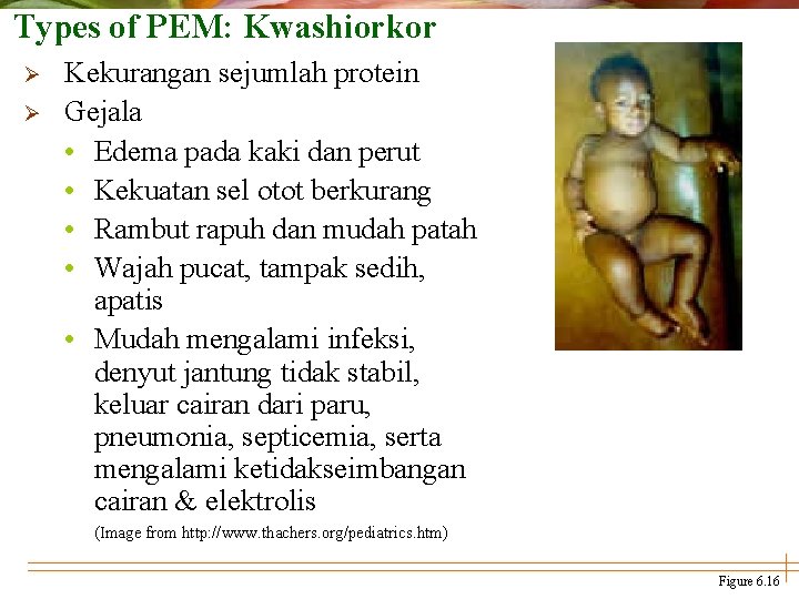 Types of PEM: Kwashiorkor Ø Ø Kekurangan sejumlah protein Gejala • Edema pada kaki