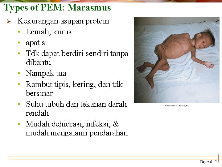 Types of PEM: Marasmus Ø Kekurangan asupan protein • Lemah, kurus • apatis •