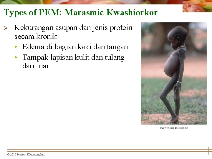 Types of PEM: Marasmic Kwashiorkor Ø Kekurangan asupan dan jenis protein secara kronik •