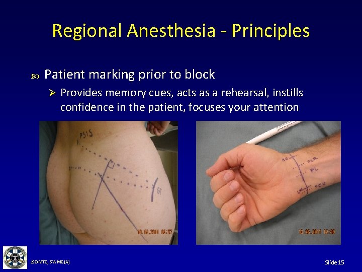 Regional Anesthesia - Principles Patient marking prior to block Ø Provides memory cues, acts
