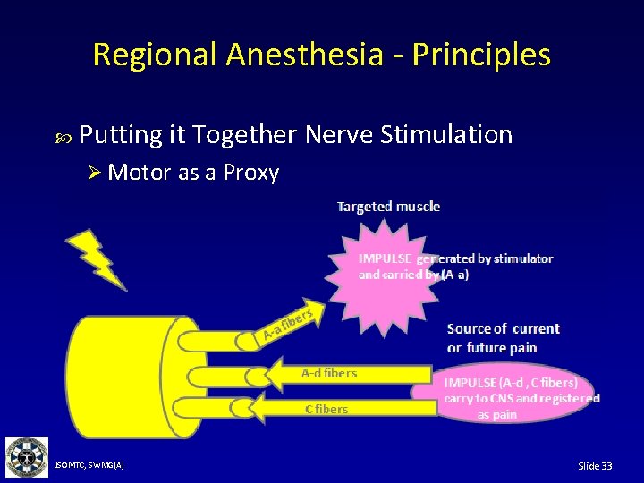 Regional Anesthesia - Principles Putting it Together Nerve Stimulation Ø Motor as a Proxy