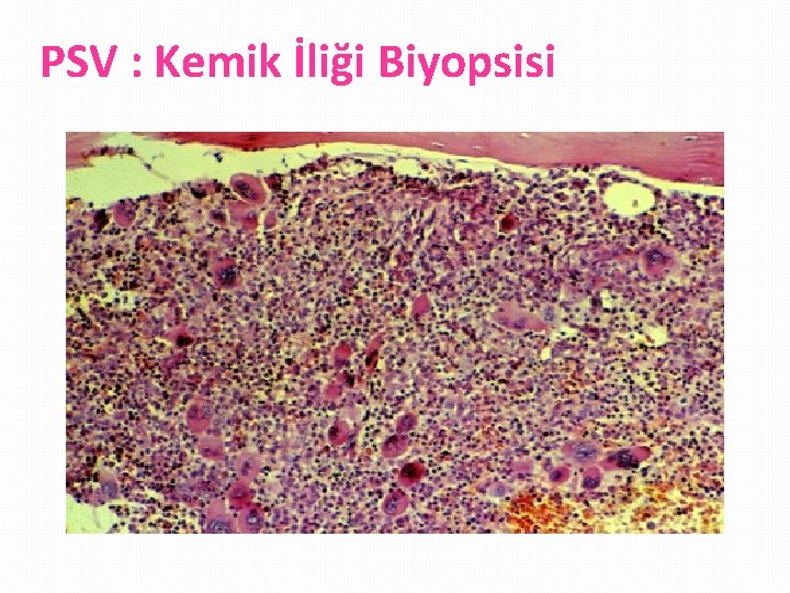 PSV : Kemik İliği Biyopsisi 