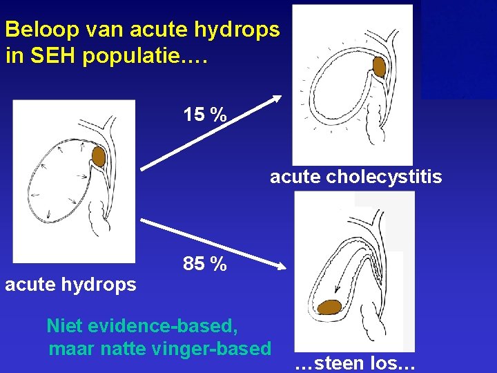 Beloop van acute hydrops in SEH populatie…. 15 % acute cholecystitis acute hydrops 85