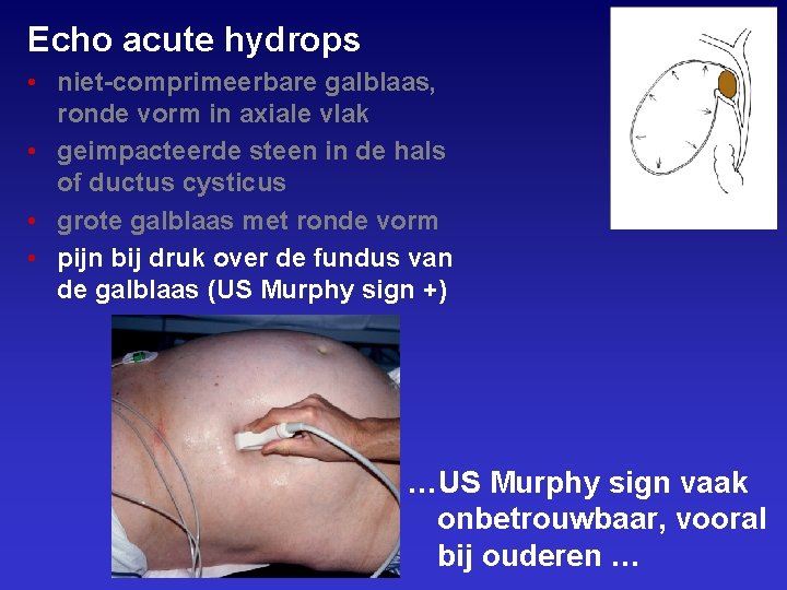 Echo acute hydrops • niet-comprimeerbare galblaas, ronde vorm in axiale vlak • geimpacteerde steen