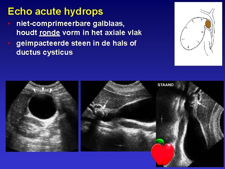 Echo acute hydrops • niet-comprimeerbare galblaas, houdt ronde vorm in het axiale vlak •